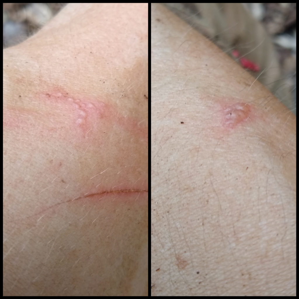 Skin blisters from exposure to Ruta graveolens
